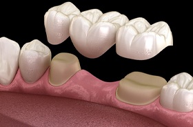 dental bridge illustration