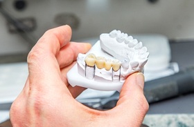 dental bridge model