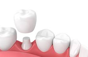 dental crown illustration