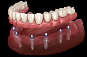 Illustration of implant denture for lower arch against dark background