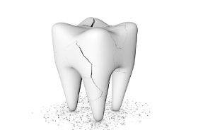 Illustration of badly damaged tooth that may need to be extracted