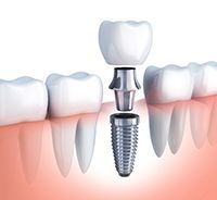 Illustration of titanium alloy dental implant, abutment, and crown
