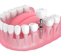 Single dental implant and crown in lower dental arch