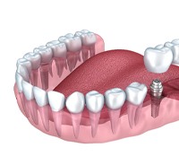 Illustration of three-unit dental implant bridge in lower arch
