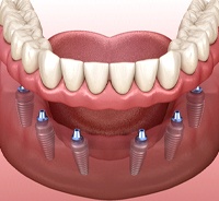 Illustration of implant denture supported by six dental implants