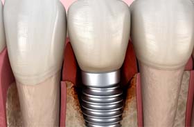 Illustration of peri-implantitis, a common cause of dental implant failure