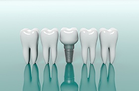 Dental implants in Plymouth next to model teeth for comparison