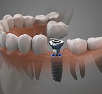 Diagram of a single tooth dental implant in Plymouth being placed
