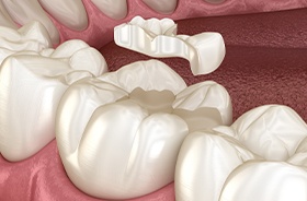 graphic of metal free filling