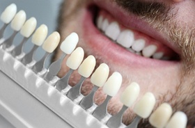 cosmetic dentistry shade matching