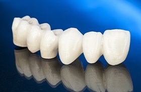 Model dental bridge before placement