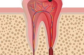 Illustration showing infected tooth that may need root canal therapy in Abington