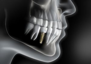 Dental implant in mouth of patient with bruxism in Plymouth