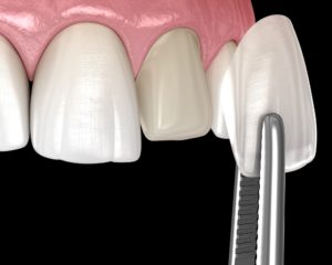 Illustration of replacing veneers in Plymouth on front tooth