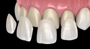 Illustration of teeth and veneers