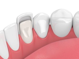 Illustration of veneer attached to front tooth